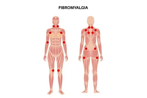 fibromyalgia